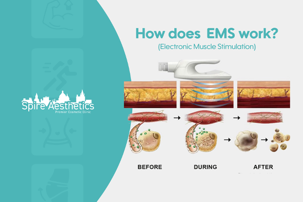 EMS treatment for post pregnancy weight loss treatment Greenhead