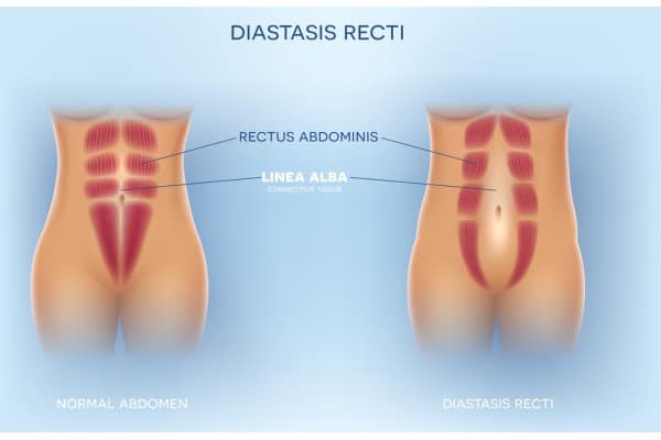 What Non-Surgical Options Are Available for Diastasis Recti Greenhead?