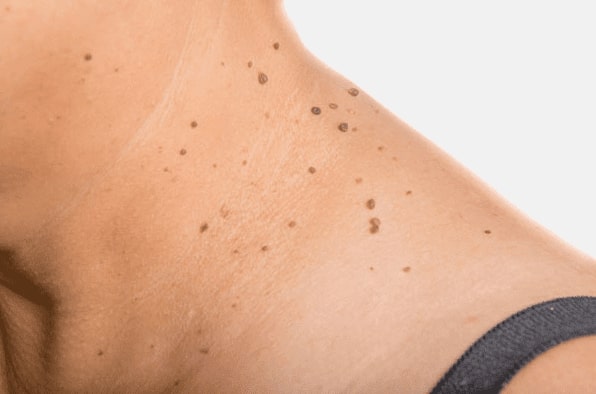 Are you looking for easy skin tag removal Greenhead - then contact Spire today!