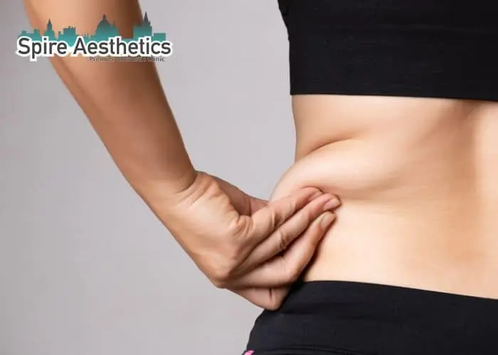 Image of woman pinching fat on their hips Greenhead. Fat Freezing treatment
