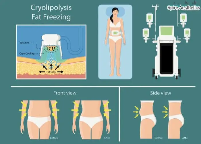 Fat freezing treatment Greenhead benefits for competitions to remove stubborn fat deposits.