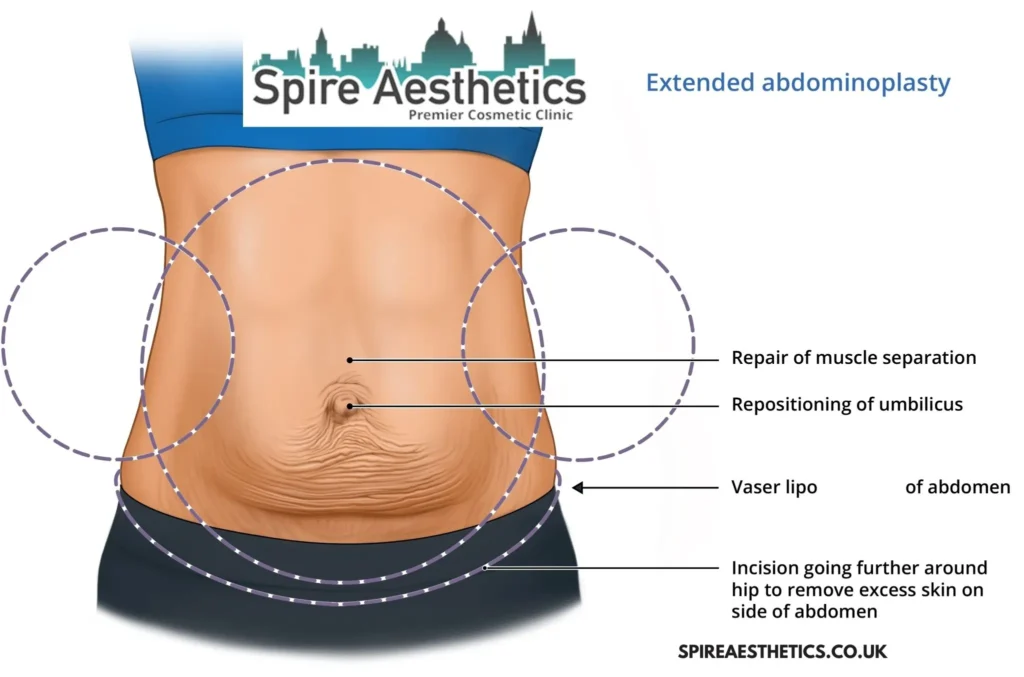 Understanding Loose Skin After Gastric Band Greenhead Surgery and HIFU Treatment