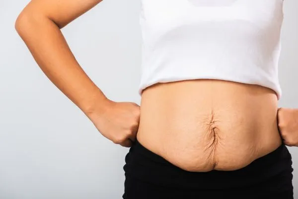 Image of a woman's stomach after weight loss with sagging skin following a gastric band Greenhead