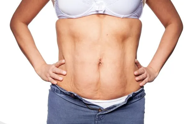 sagging skin on woman's stomach after weight loss injections Greenhead
