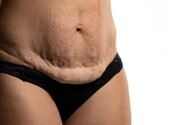 Image of womans stomach after weight loss injections Greenhead showing saggy skin