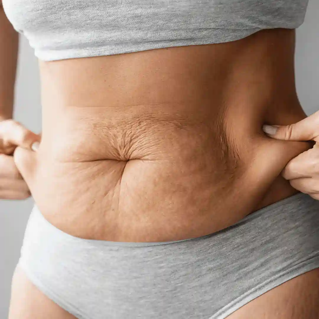 Is It Normal to Have Loose Skin After Pregnancy Greenhead?